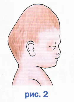capul nou-nascut, forma capului fetal, cephalohematoma
