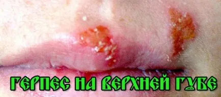 Herpes (rece) pe buze - tratamentul erupții cutanate neplăcute, tratamentul la domiciliu