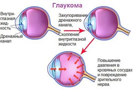 Глаукома възниква защо и как да се предотврати болестта