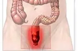 Proctosigmoiditis - a besorolás a betegség, a tünetek és a kezelés jellemzői