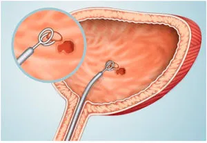 Cancerul de vezica urinara la barbati, simptome, cauze si tratamente