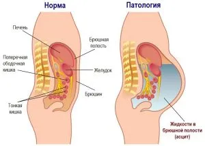 рак на яйчниците при жените - симптоми, лечение, прогноза