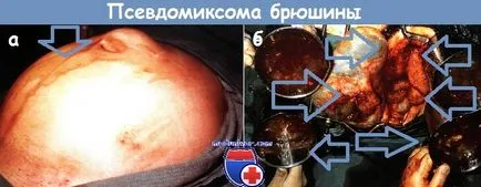 pseudomyxoma перитонеума