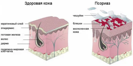 Псориазис лечение, видове и какво е то