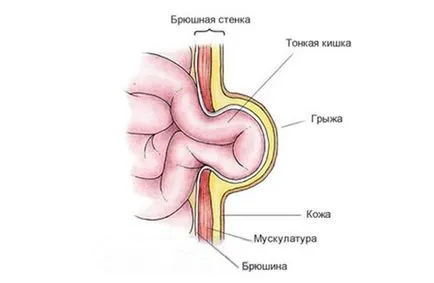 Пъпна херния при новородени за лечение