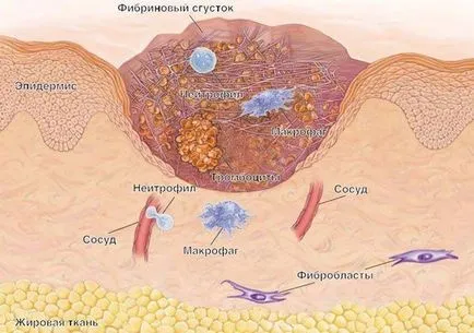 tratament psoriazis, tipuri și ceea ce este