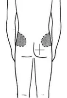 Află! Cum se face o injecție intramusculară, injecție intramusculară, o injecție în fese, împușcat în coapsă