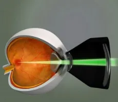 Rehabilitáció után lézeres koaguláció a retina