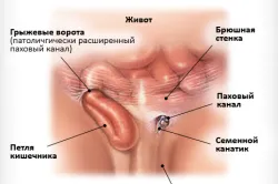 Рехабилитация след отстраняване на ингвинална херния