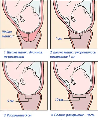 Разкриване на шийката на матката