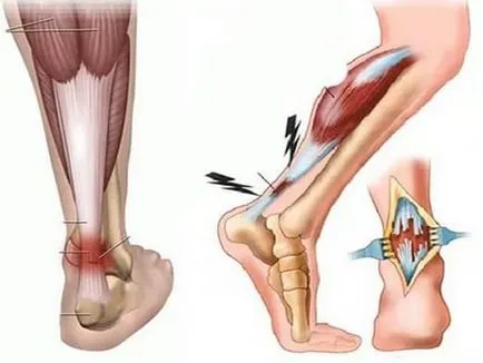 Achilles-ín szakadás időzítését és eljárás kezelésére rehabilitációs