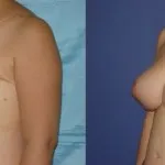 реконструкция на гърдата след мастектомия - цената на операцията (снимка)