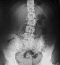 Рентгенови лъчи на лумбалния отдел на гръбначния стълб-сакрална стойност, подготовка, снимката