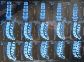 Рентгенови лъчи на лумбалния отдел на гръбначния стълб-сакрална стойност, подготовка, снимката