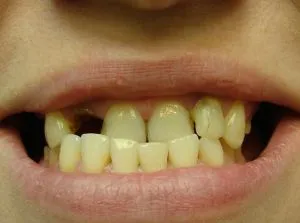 Retrusion и изпъкване на класификацията за зъби, симптоми, корекция