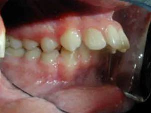 Retrusion и изпъкване на класификацията за зъби, симптоми, корекция