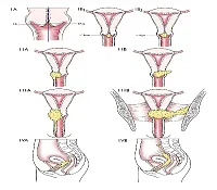 Simptomele de tratament a cancerului de col uterin și diagnosticare (cancer Colli uterină)