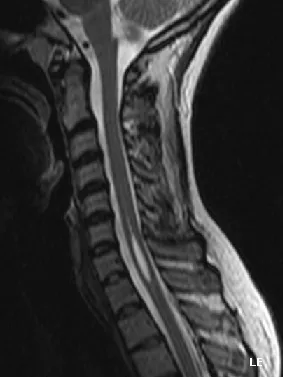 Syringomyelia mi ez, miért van