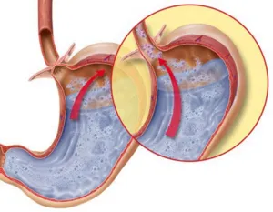 Simptomele și tratamentul esofagita de reflux medicamente medicamente, terapie fizică și acasă căi de atac