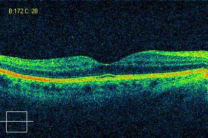 Симптоми и диагноза на окото макулна дегенерация заболяване