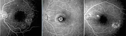 Симптоми и диагноза на окото макулна дегенерация заболяване
