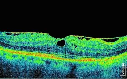 Simptome si diagnostic de ochi degenerescenta maculara bolii