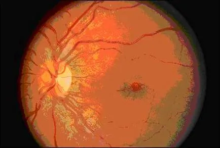 Simptome si diagnostic de ochi degenerescenta maculara bolii