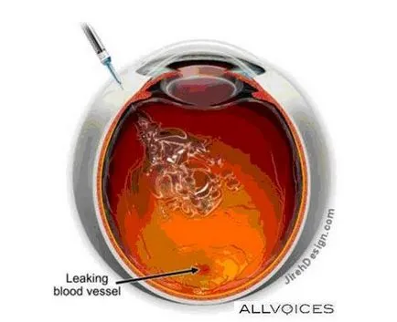 Симптоми и диагноза на окото макулна дегенерация заболяване