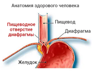 Хиатална херния лечение у дома - възпалено гърло - Издател - фолк