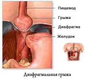 Хиатална херния лечение у дома - възпалено гърло - Издател - фолк