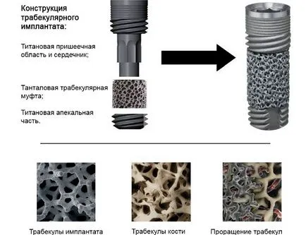 Az implantátumok Zimmer jellemzői és előnyei, fajta és tartósság