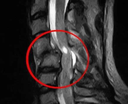 Spinala de recuperare a prejudiciului din cordonul ombilical, reabilitare