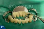 cikk periodontitis