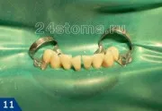 cikk periodontitis