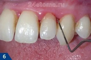 cikk periodontitis