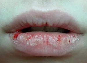 Сухи устни - причинява заболяване,