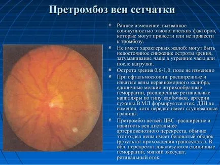 Trombózis szemében a retina központi véna - a tünetek és a trombózis kezelésére CMC