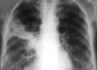 tuberculoză pulmonară infiltrativă - cauze, simptome, diagnostic și tratament