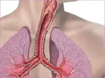 Вдишването тонзилит ефективен метод в комплекс лечението