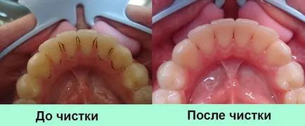 Ултразвуково почистване на зъбите - показания и противопоказания