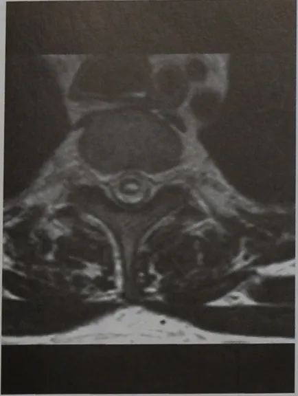 Uschestvennaya локализиране и симптоми на шийката на матката и гръбнака на гръдния кош