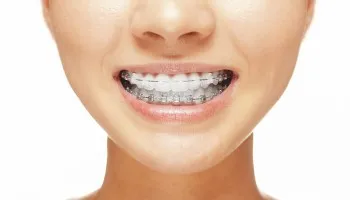 Gondozása a fogak fehérítés után - a nők egészségének
