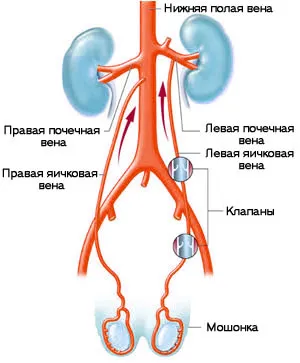 Варикоцеле и безплодие връзка между заболявания