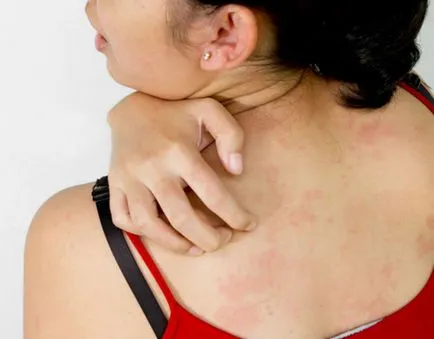 Care este diferența eczeme și psoriazis, modul în care acestea diferă