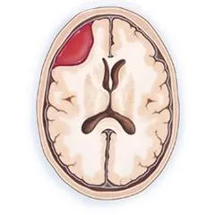 Intracranialis vérömleny - tünetek, kezelés