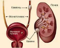 Всички камъни в бъбреците и тяхното лечение