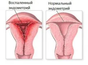 възпаление на матката - ендометрит лечение на народната медицина