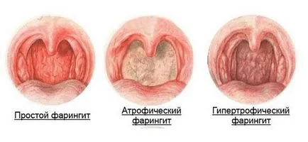 Simptomele cronice faringita granuloasă la copii și adulți, tratament