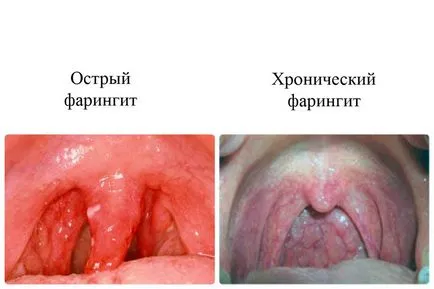 Simptomele cronice faringita granuloasă la copii și adulți, tratament