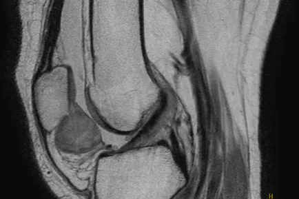 chondromatosis a térd kezelés